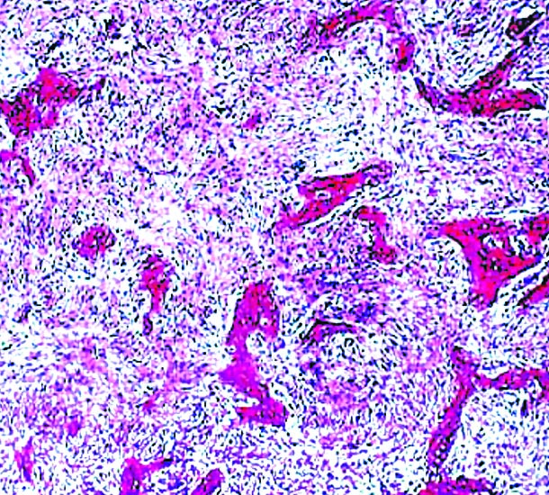 Osteoblastoma Pathology Outlines